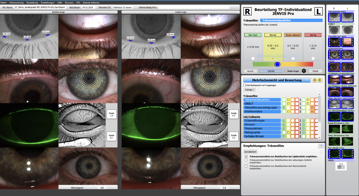 Advanced diagnostic testing using the Oculus Keratograph