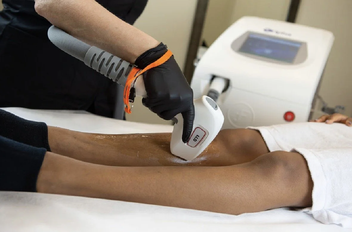 Photoépilation Laser