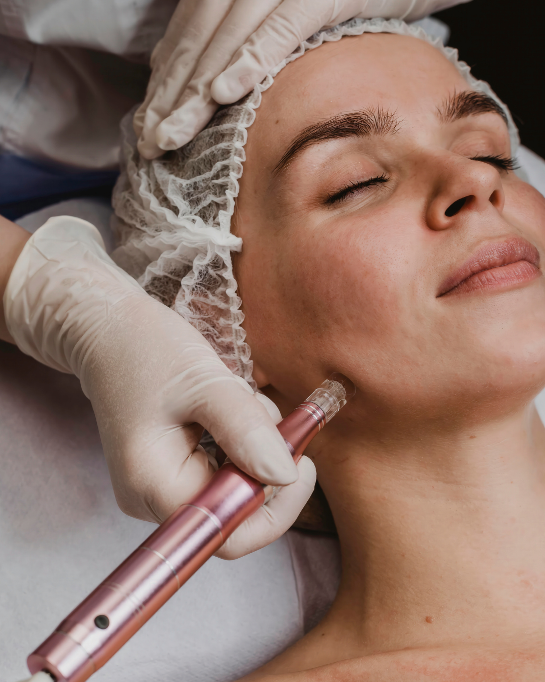 Microneedling
