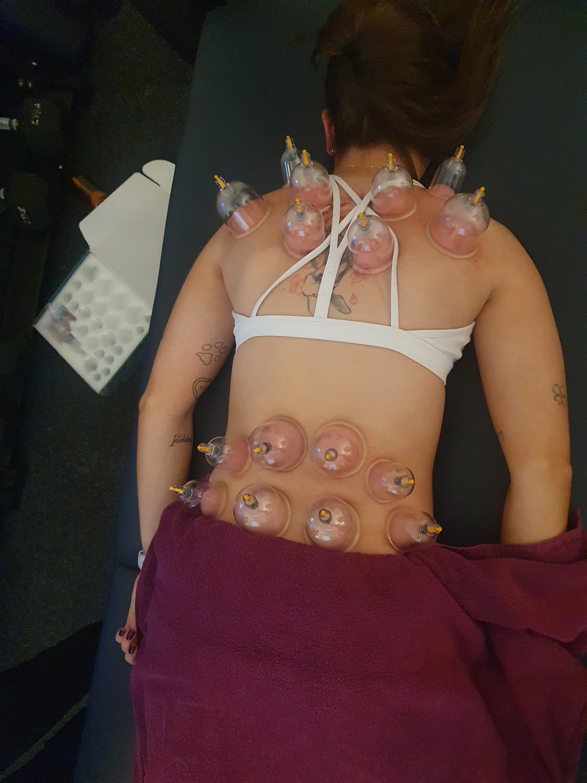 A person lying on a massage table with multiple cupping therapy cups on their back and abdomen, wearing a white tank top and a burgundy towel covering their lower body.