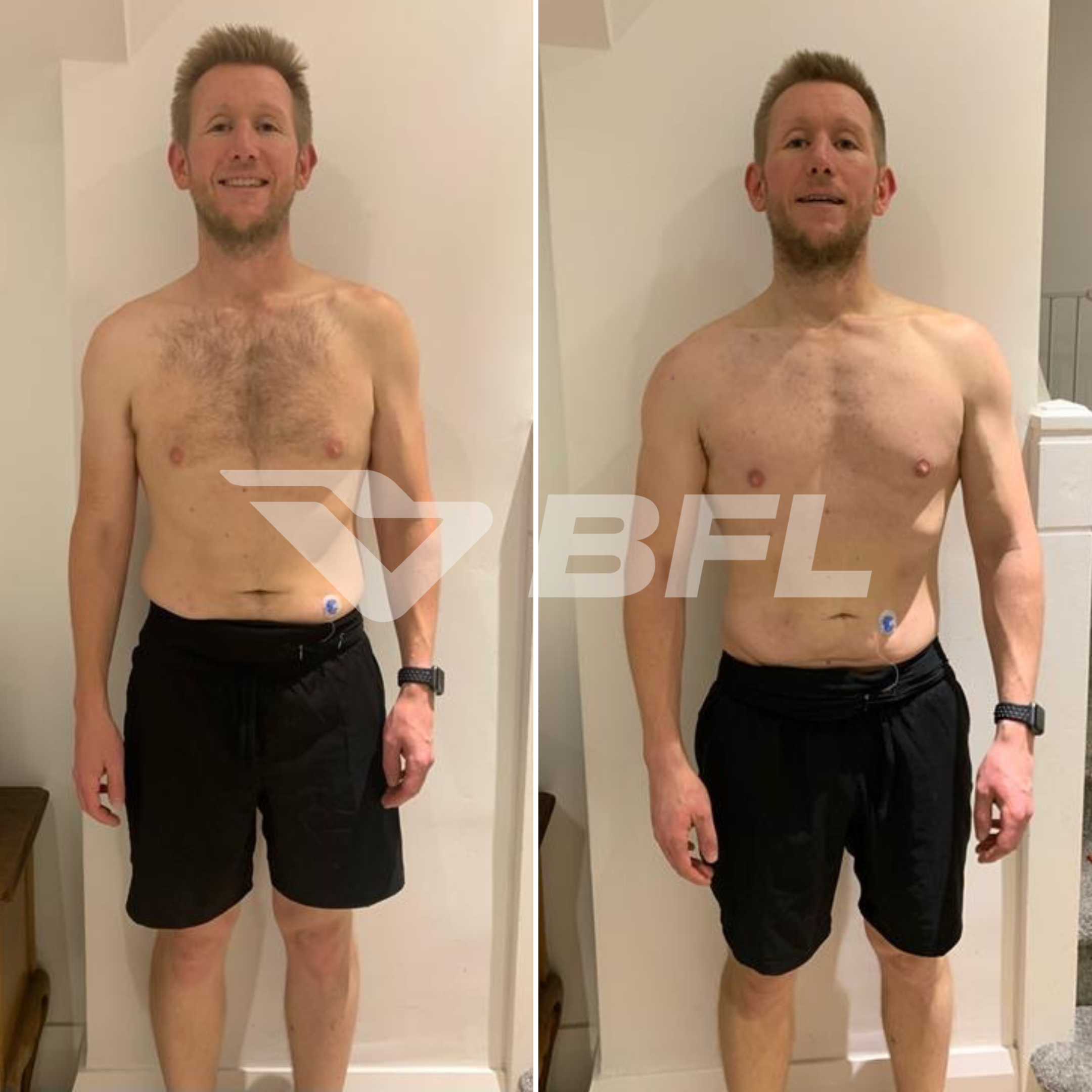 Side-by-side comparison of a shirtless man before and after his fitness transformation. In both images, he is standing against a white wall, wearing black shorts and a watch, with a blue medical device attached to his lower abdomen.