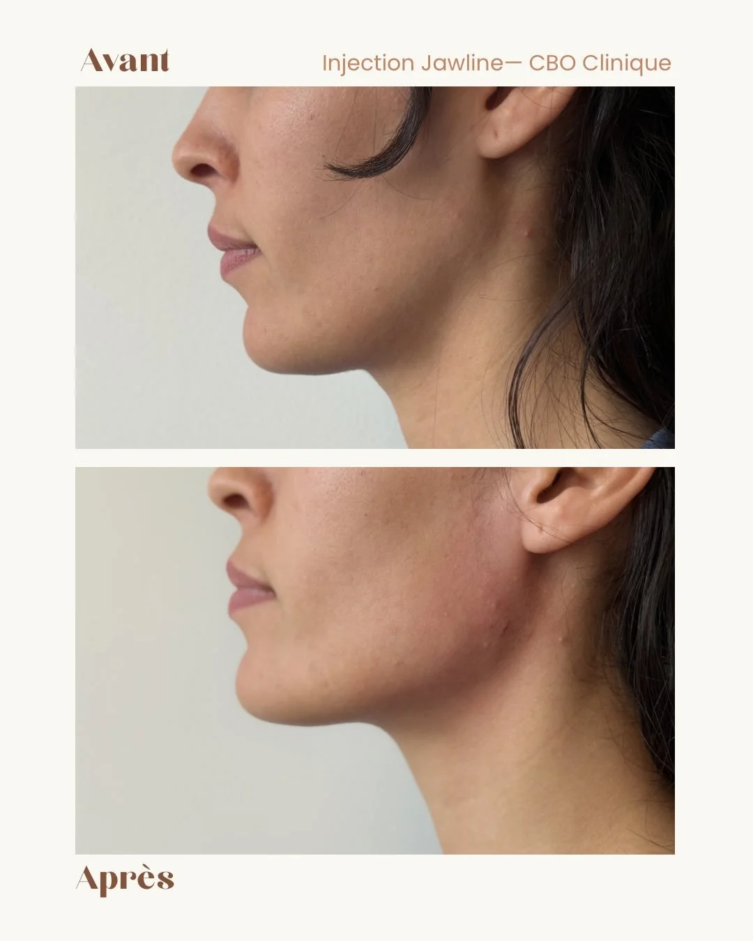 AVANT / APR&Egrave;S &mdash; Injection acide hyaluronique Jawline 

L&rsquo;acide hyaluronique est une substance naturellement pr&eacute;sente dans la peau, utilis&eacute;e en m&eacute;decine esth&eacute;tique pour restaurer les volumes et am&eacute;
