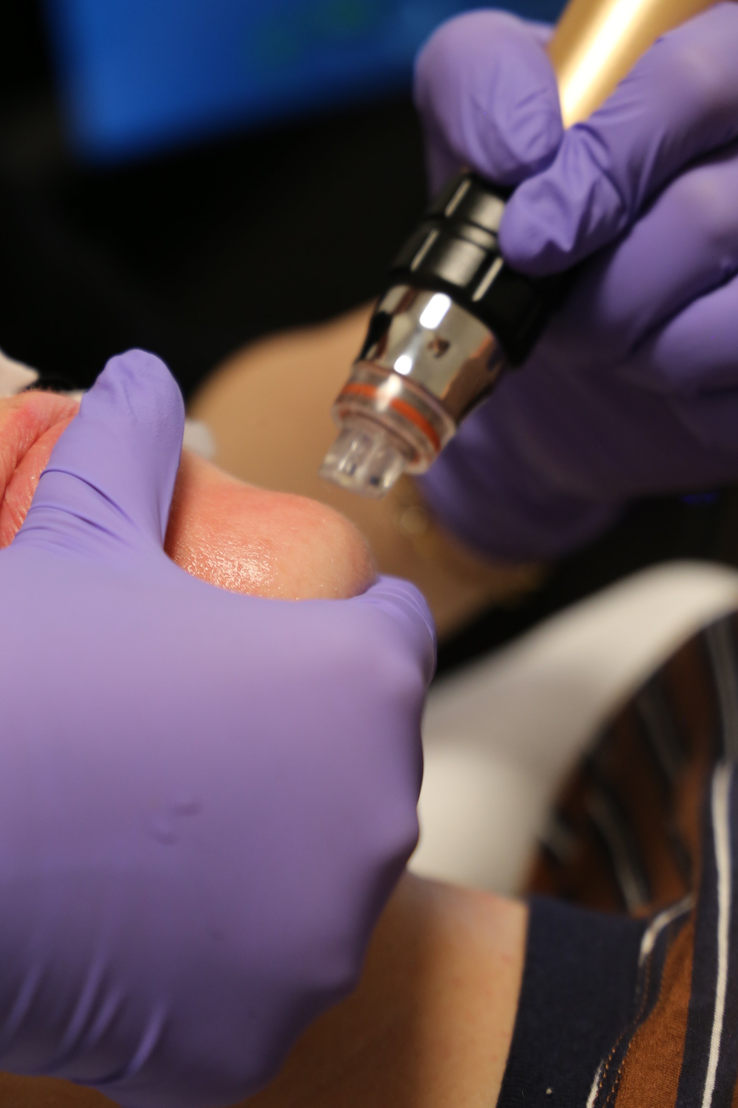 Une personne reçoit une injection ou un traitement médical à l'aide d'une seringue par un professionnel portant des gants violets.