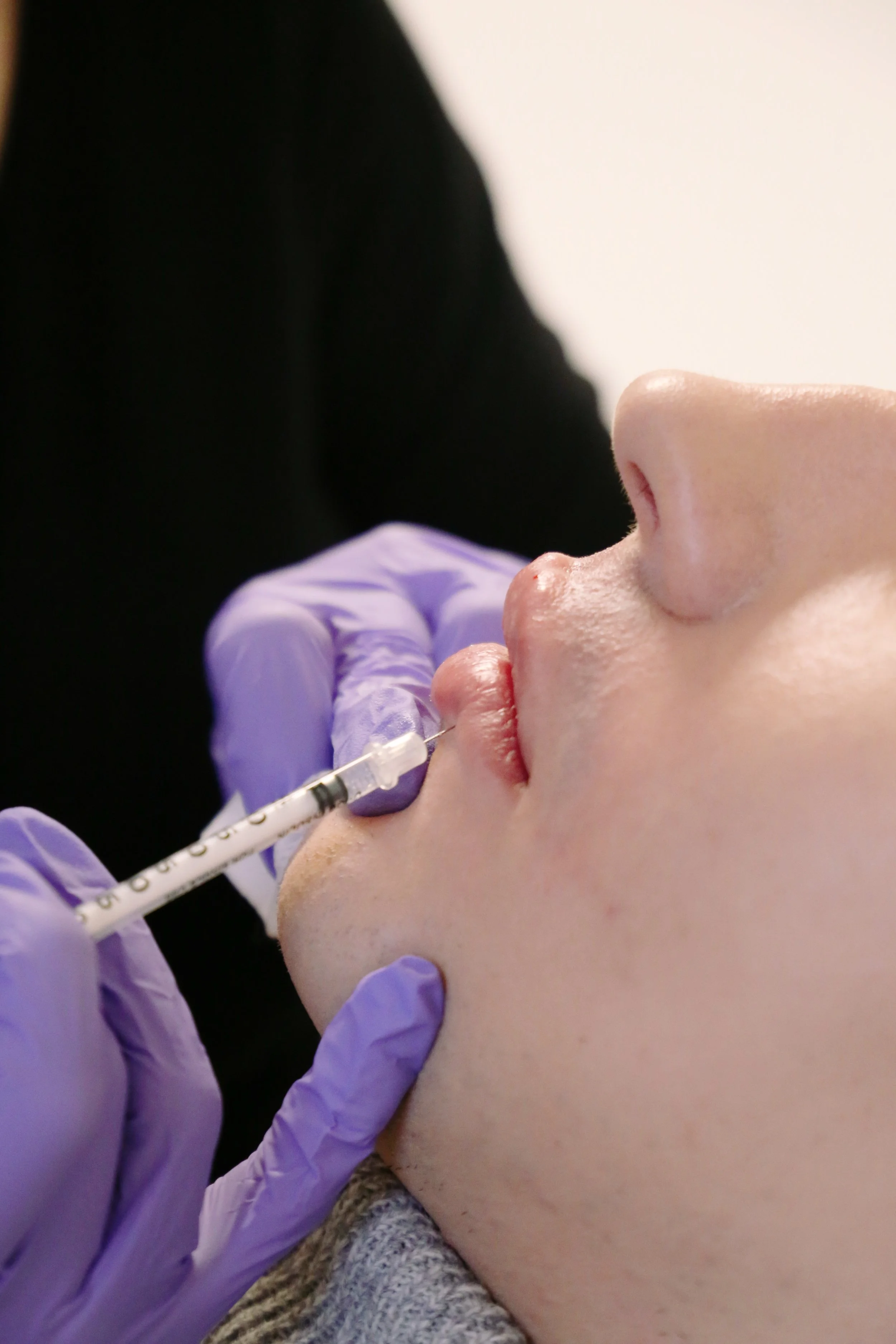 Une personne reçoit une injection de Botox dans les lèvres par un professionnel portant des gants en latex violets, en position latérale sur une table d'examen.