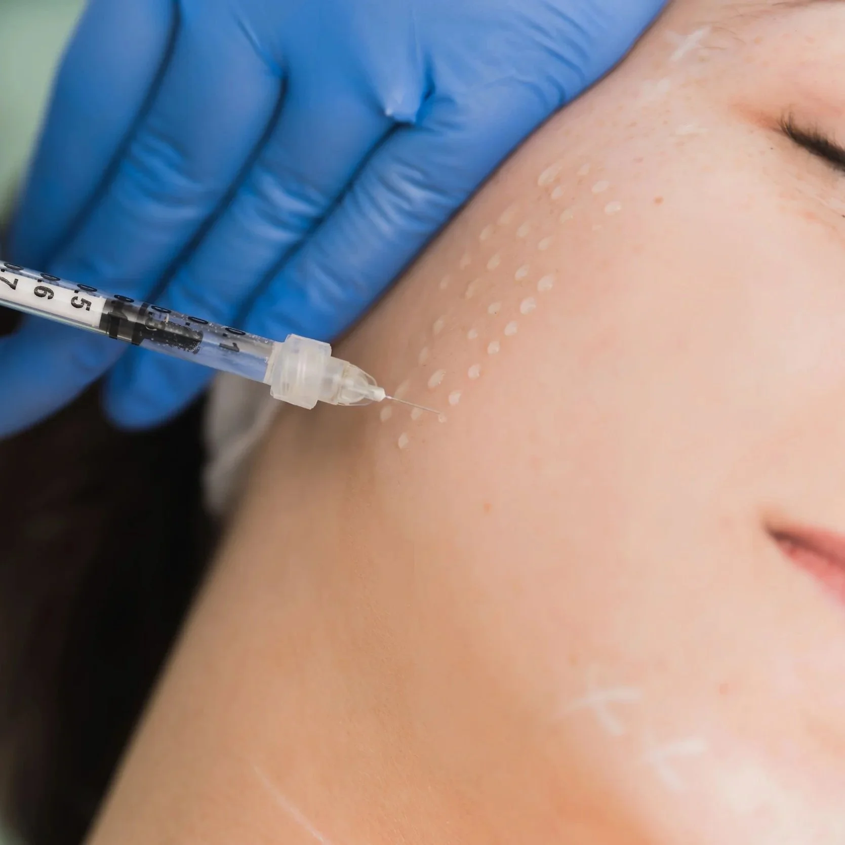 Une personne recevant une injection sous la peau, avec des marqueurs blancs sur le visage.