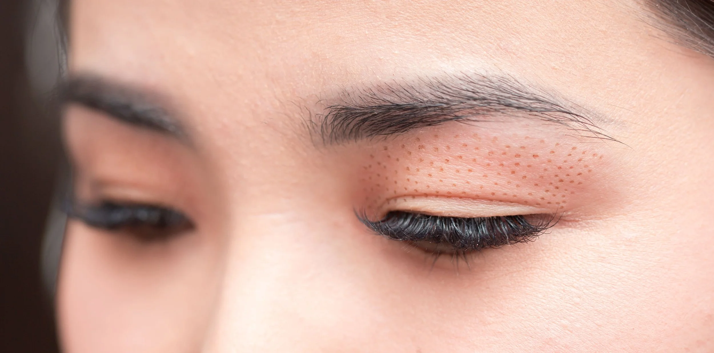 Zoom sur un œil clos d'une personne avec des petits points rouges sous la paupière.