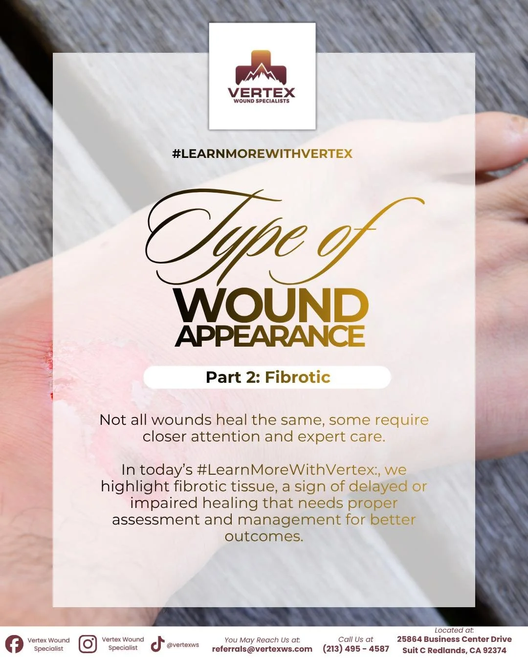 Not all wounds heal as expected and when healing is delayed, expert care becomes essential. 

In today&rsquo;s #LearnMoreWithVertex: Type of Wound Appearance (Part 2&ndash; Fibrotic), we highlight fibrotic tissue, an indicator of impaired healing tha