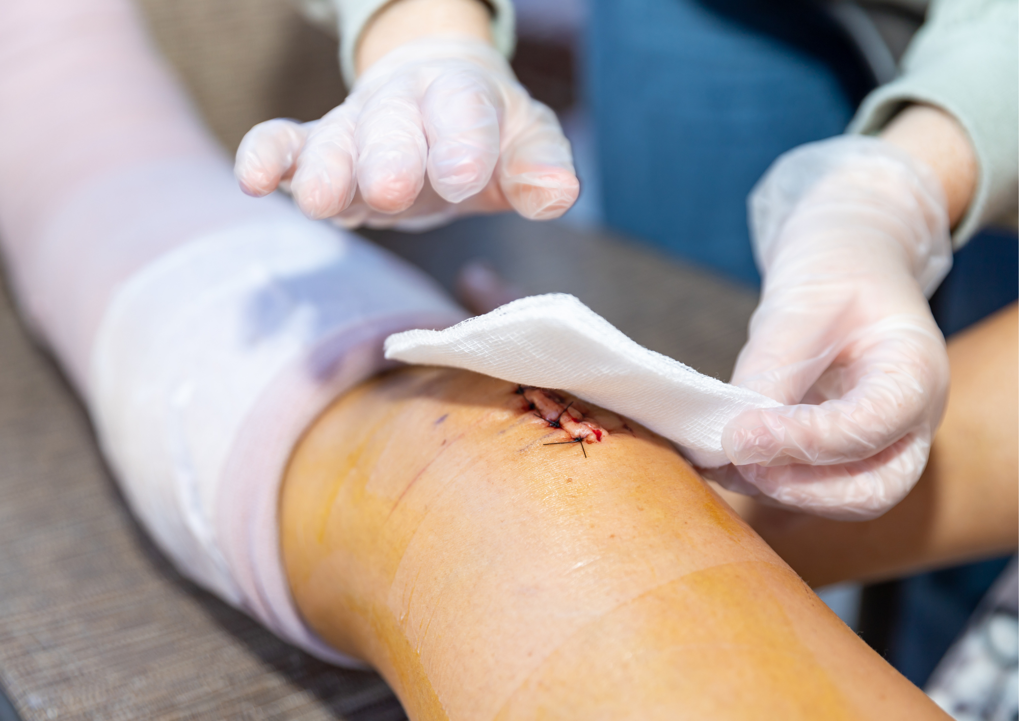 Why Chronic Wounds Won’t Heal and How Advanced Care Can Change the Outcome