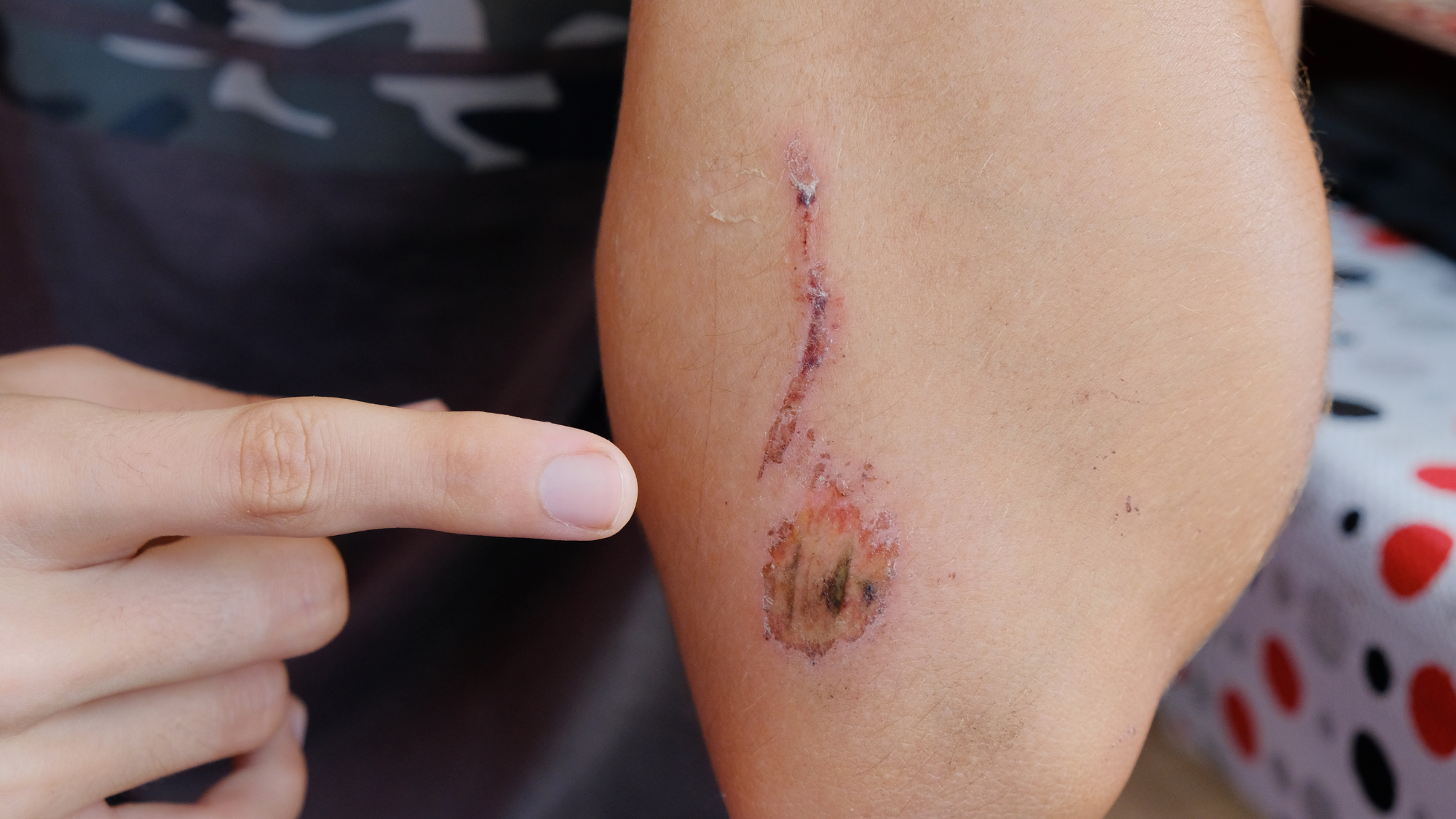 Beyond the Surface: Why Some Wounds Wear a Mask (And How to Heal Them)