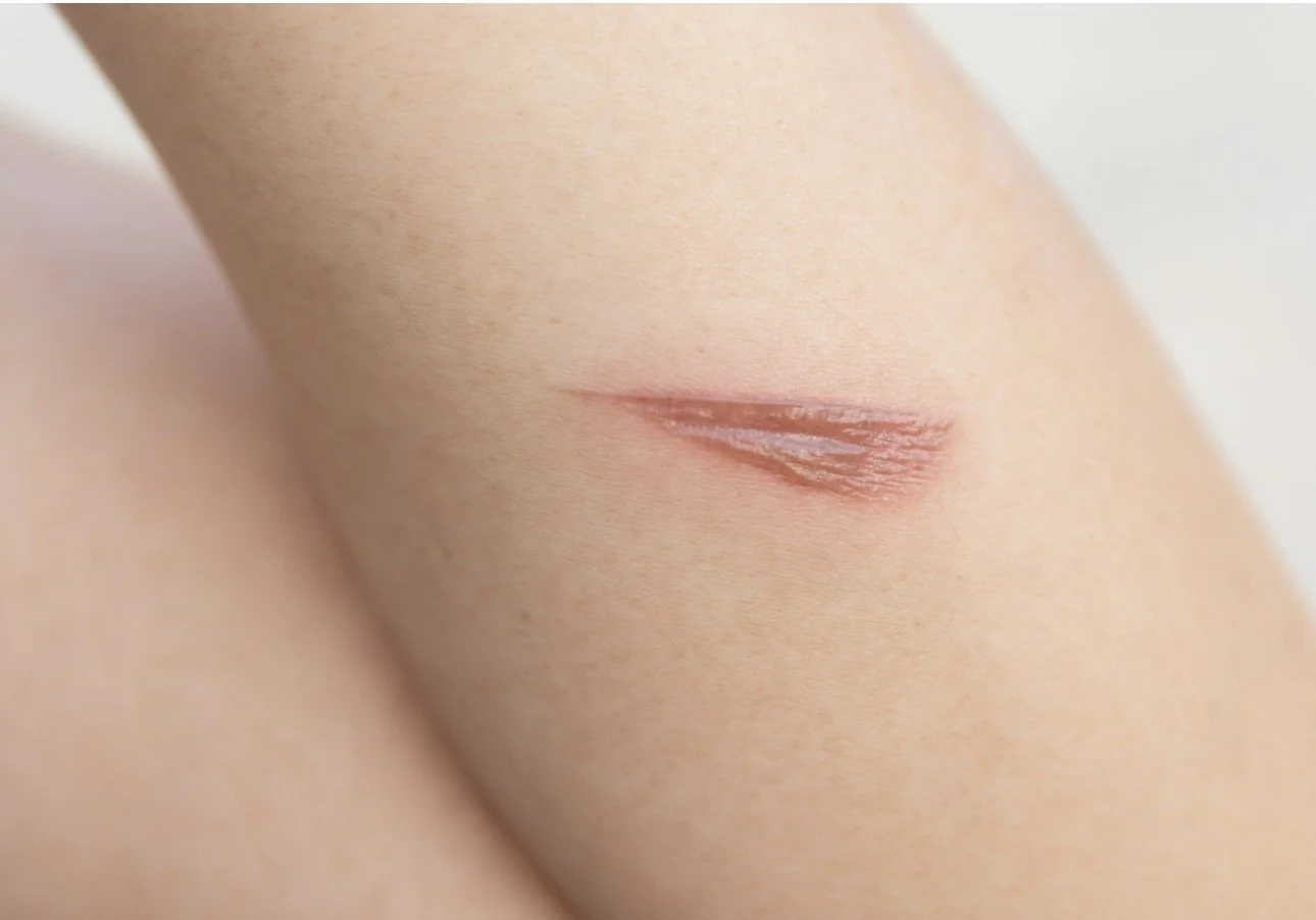 Understanding Moisture-Associated Skin Damage (MASD): Types, Prevention, and Treatment
