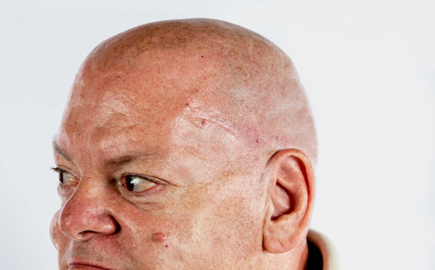 Close-up of a bald man's face showing skin imperfections and features.