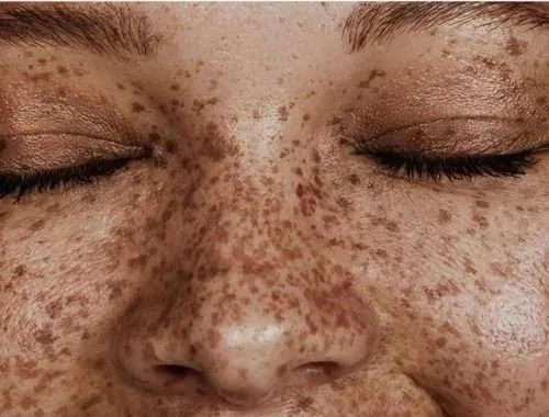 Close-up de rosto com sardas e olhos fechados.