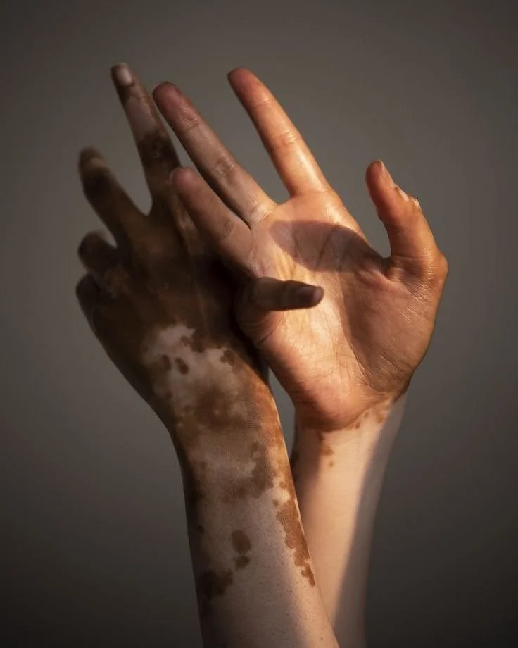 Duas mãos, uma de pele escura com manchas de vitiligo e uma de pele clara, entrelaçadas em um gesto de apoio e união, com fundo neutro e iluminação suave.