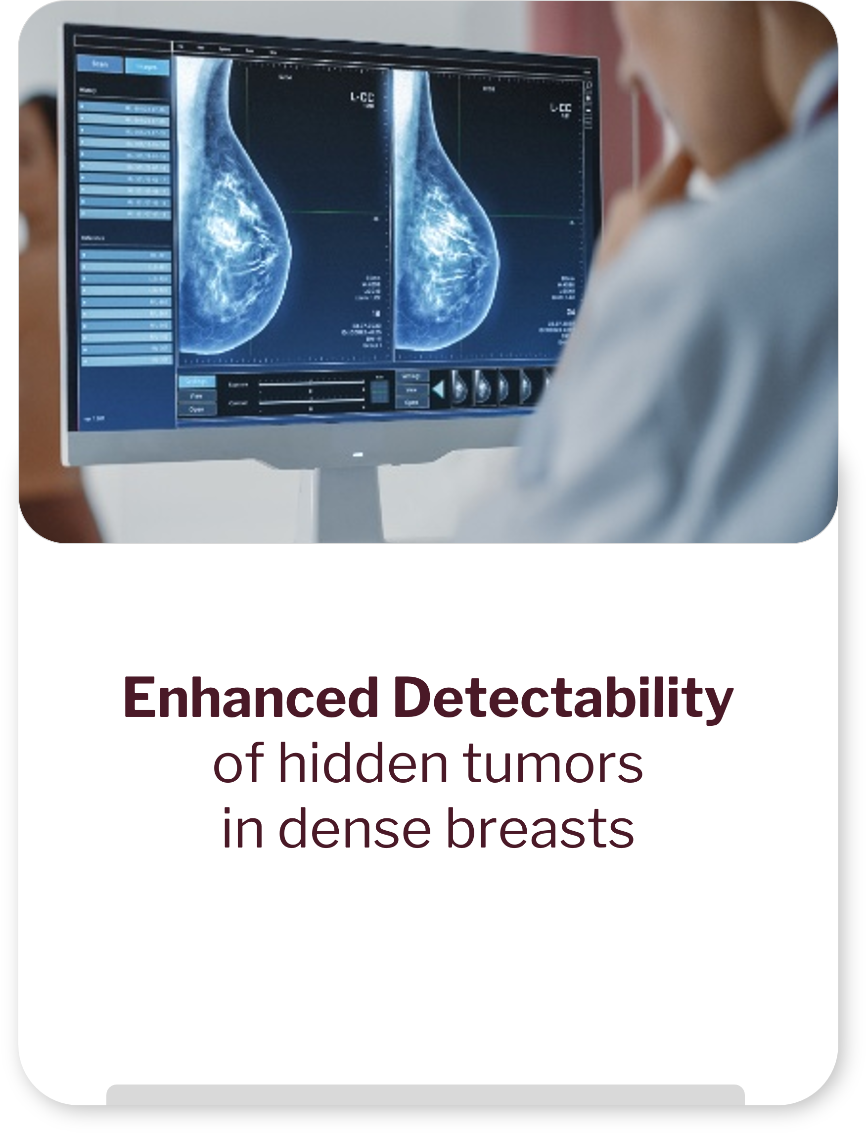 Enhanced Detectability of hidden tumors in dense breasts