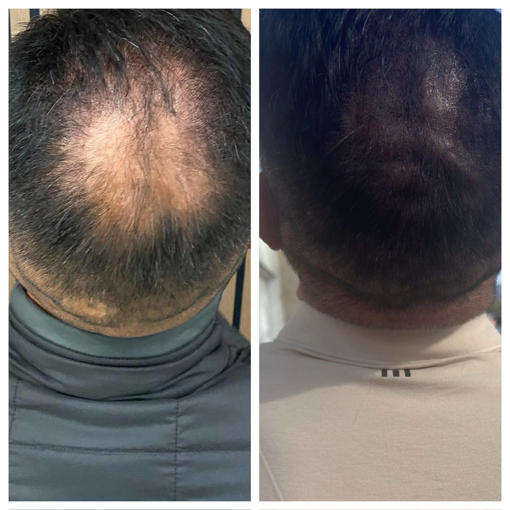 Comparison of a man's scalp before and after hair replacement; the left shows significant hair thinning and baldness, the right shows thicker, fuller hair.