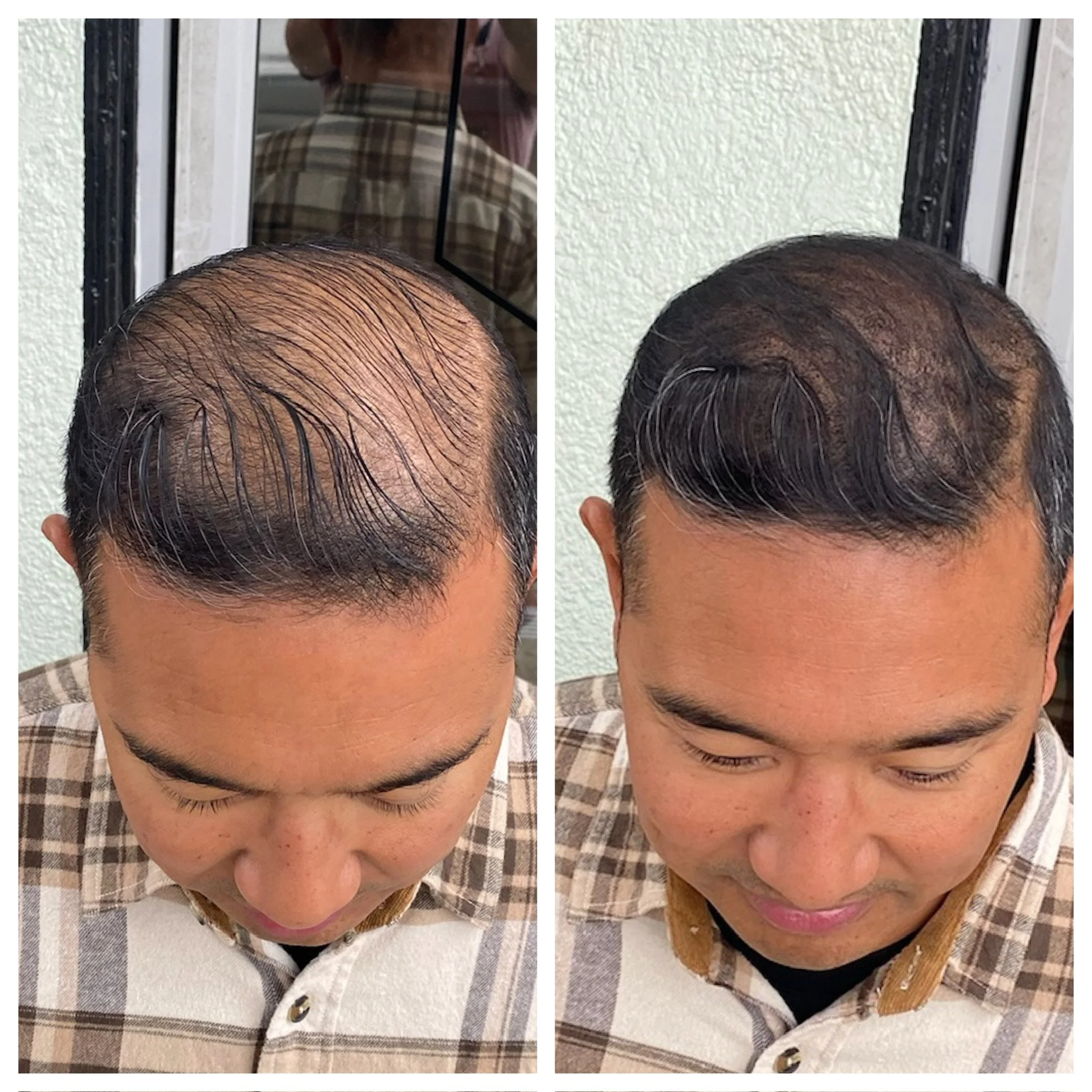 Comparison of a man's hair before and after hair replacement with SMP, showing significant hair density improvement.