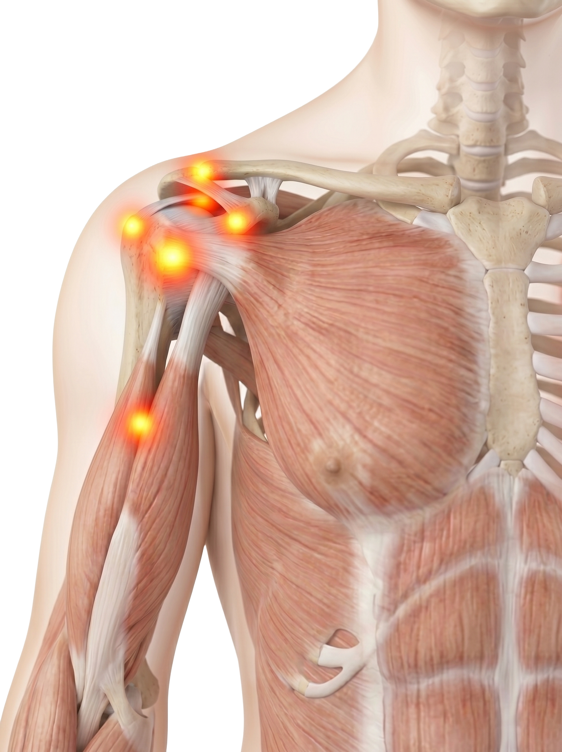 An anatomical illustration of the shoulder muscles showing pain points with glowing yellow and red spots.