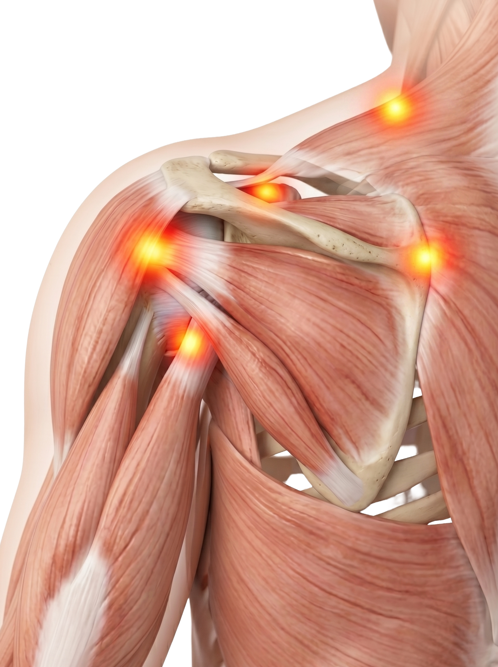 Anatomical illustration of the shoulder joint showing muscles, tendons, and bones with highlighted areas indicating pain or injury.