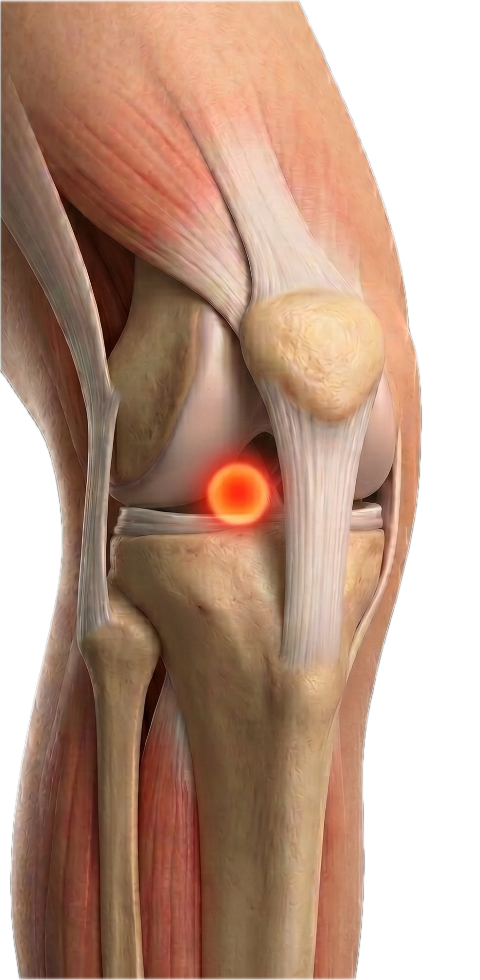 Anatomic illustration of a human knee joint showing bones, ligaments, and a highlighted area indicating pain or injury.