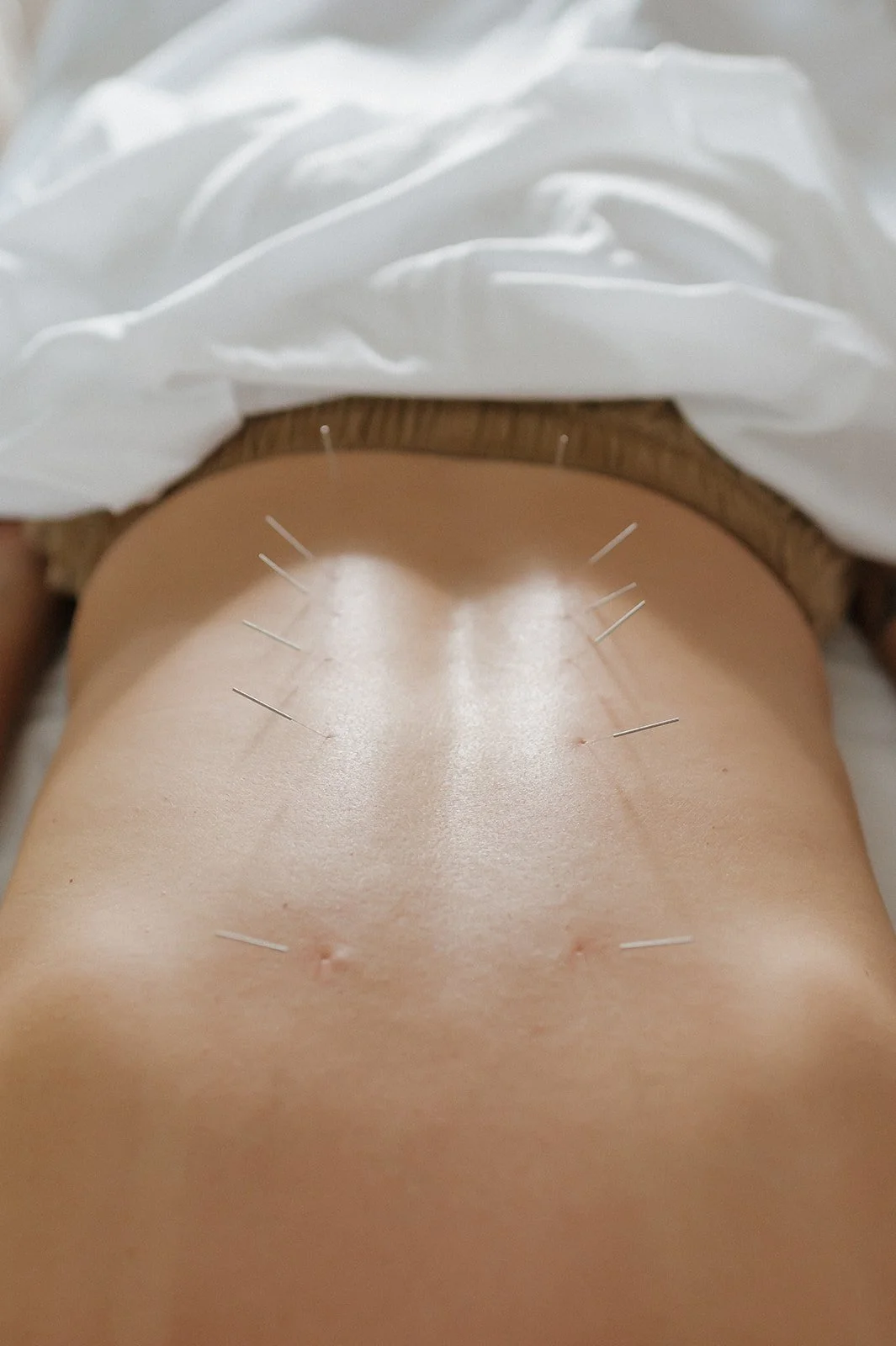 Close-up of a person's bare back with several acupuncture needles inserted around the navel area.
