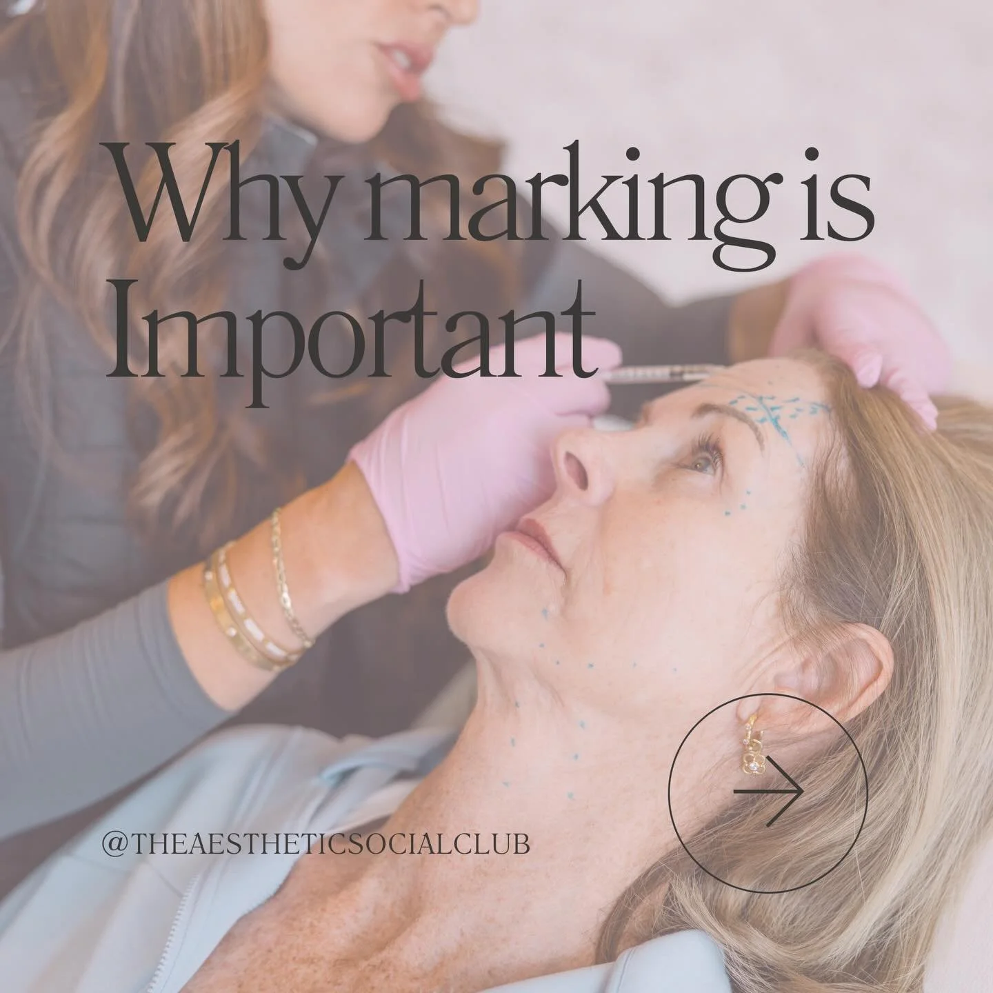 Those little dots matter ✨💉

Marking allows us to tailor your Botox to your unique facial movement, ensuring natural results that enhance&mdash;not freeze, your expression 🤍

#medspa #dmvmedspa #aestheticsocialclub #explorepage #aesthetics