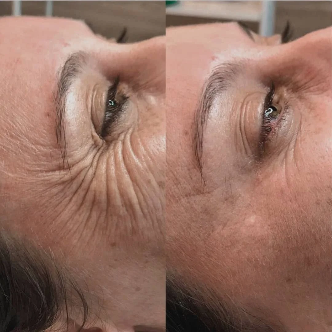 Copy of botox before & after.jpg.jpg