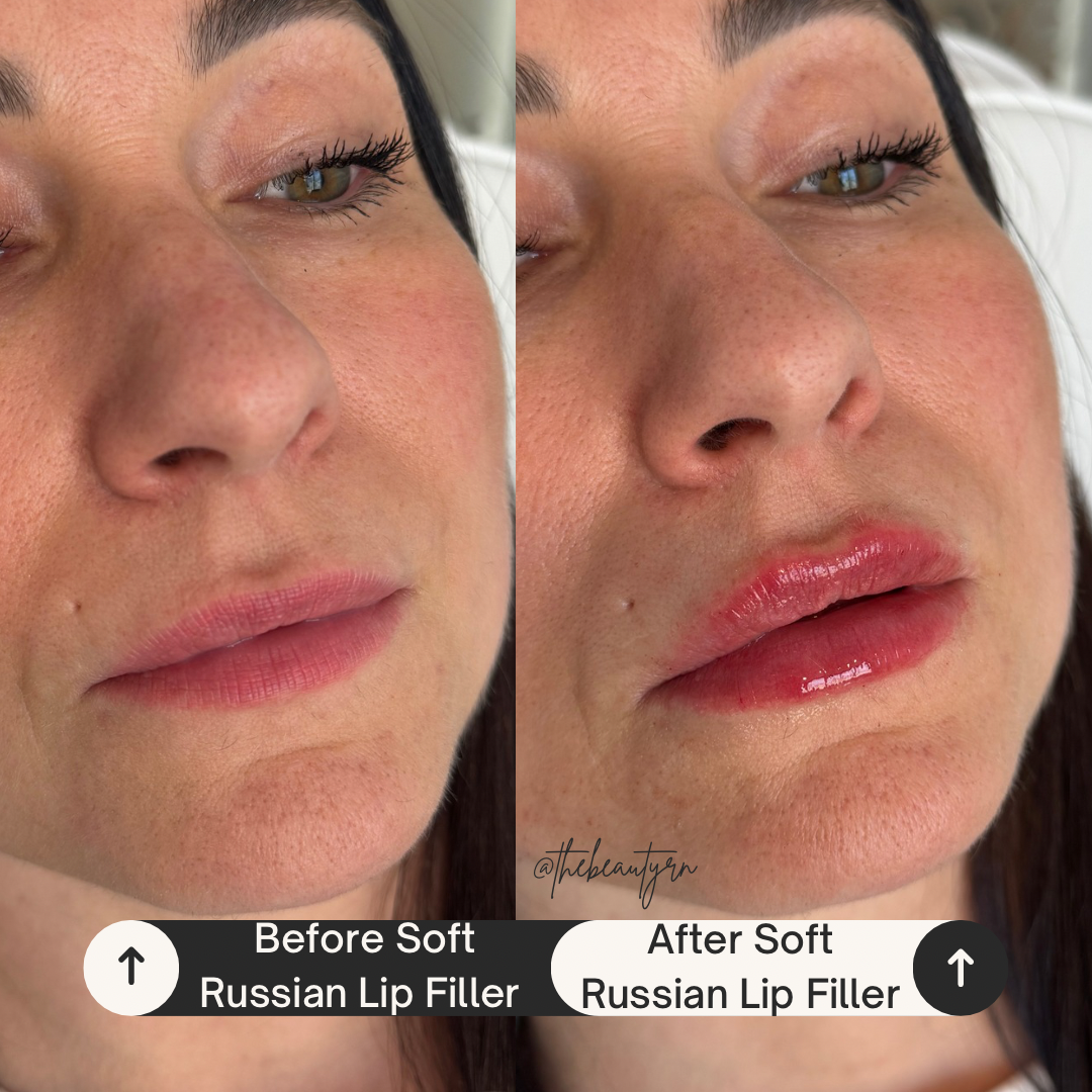 Close-up comparison of a woman's face showing the results of soft Russian lip filler, with fuller, glossier lips after treatment.