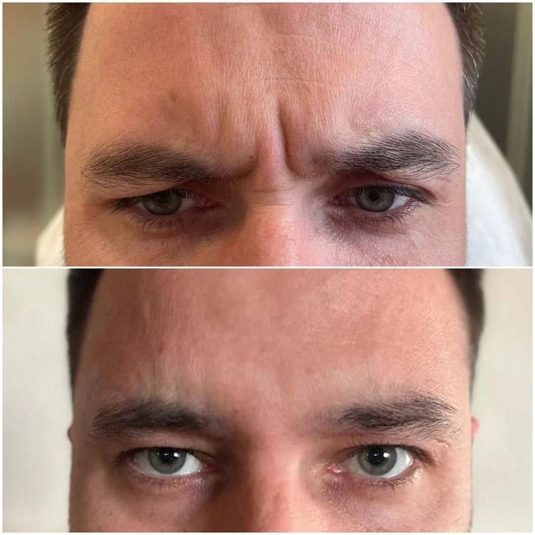 Copy of botox before & after.jpg.jpg