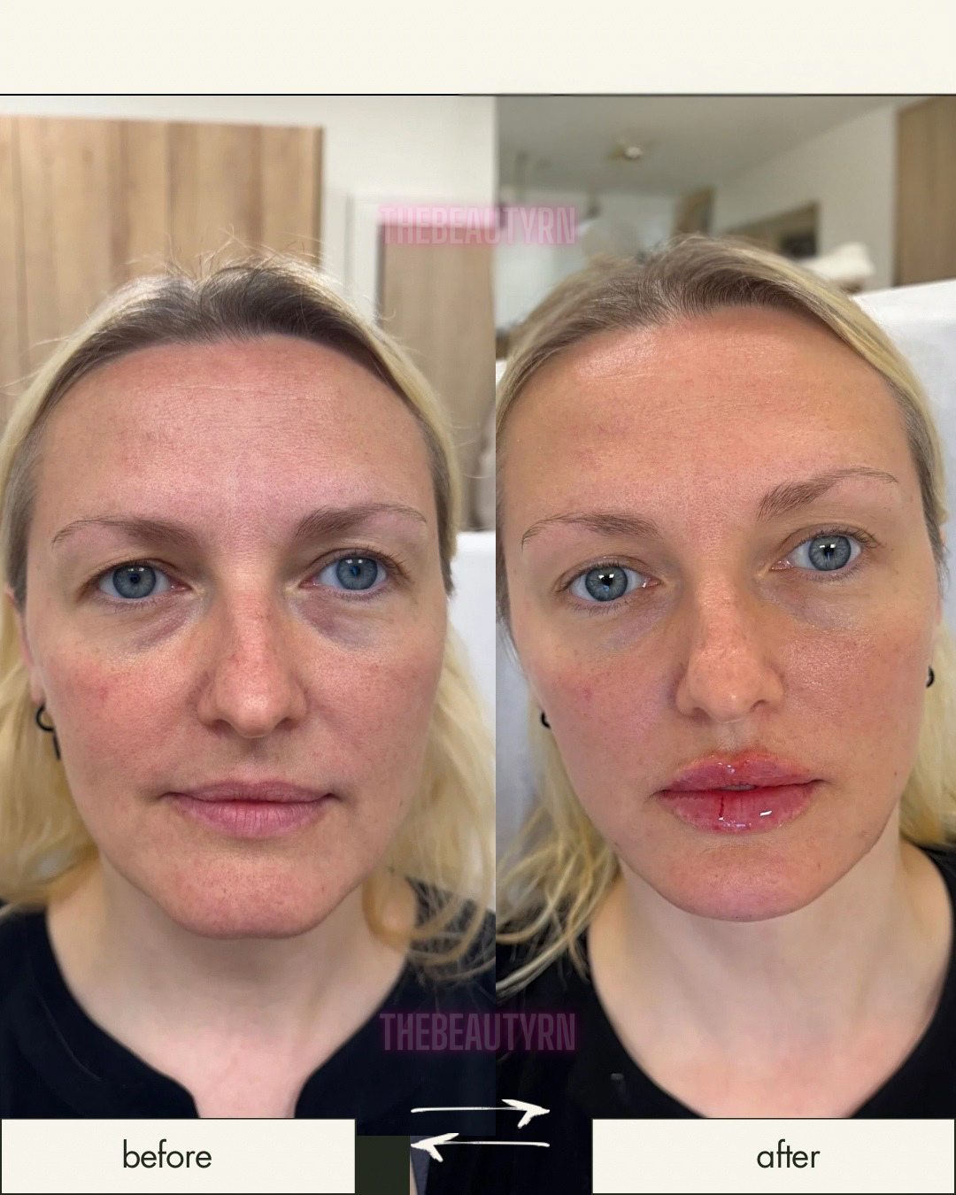 Side-by-side comparison of a woman before and after a cosmetic treatment. The woman has blonde hair and blue eyes. In the 'before' image, her skin appears slightly red and textured. In the 'after' image, her skin looks smoother, with a more even tone
