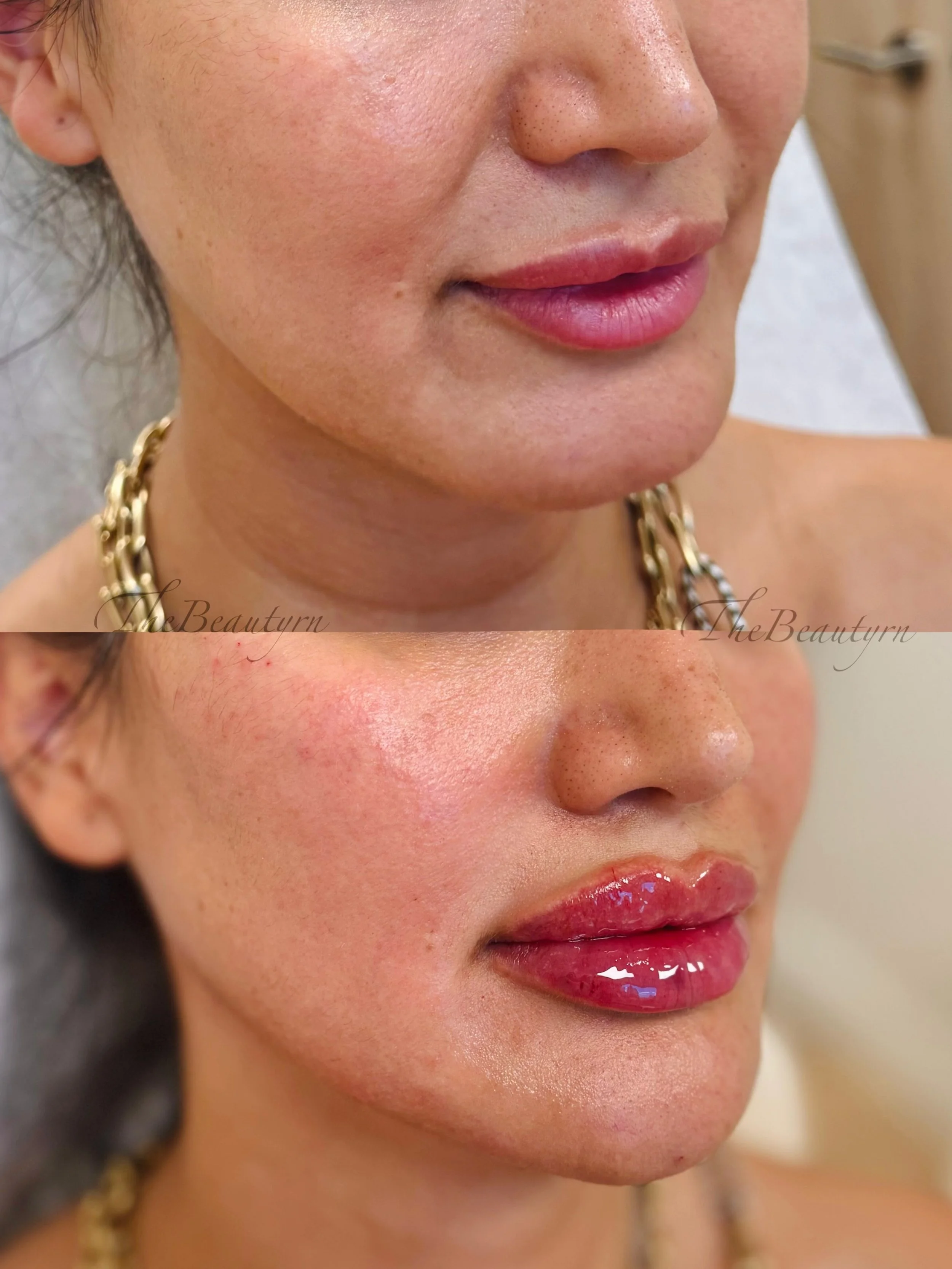 Close-up of a woman's face showing a before and after comparison of a cosmetic procedure on her lips and facial skin. The top image shows her natural lips with minimal makeup, and the bottom image shows her lips with gloss and a smoother, more radian