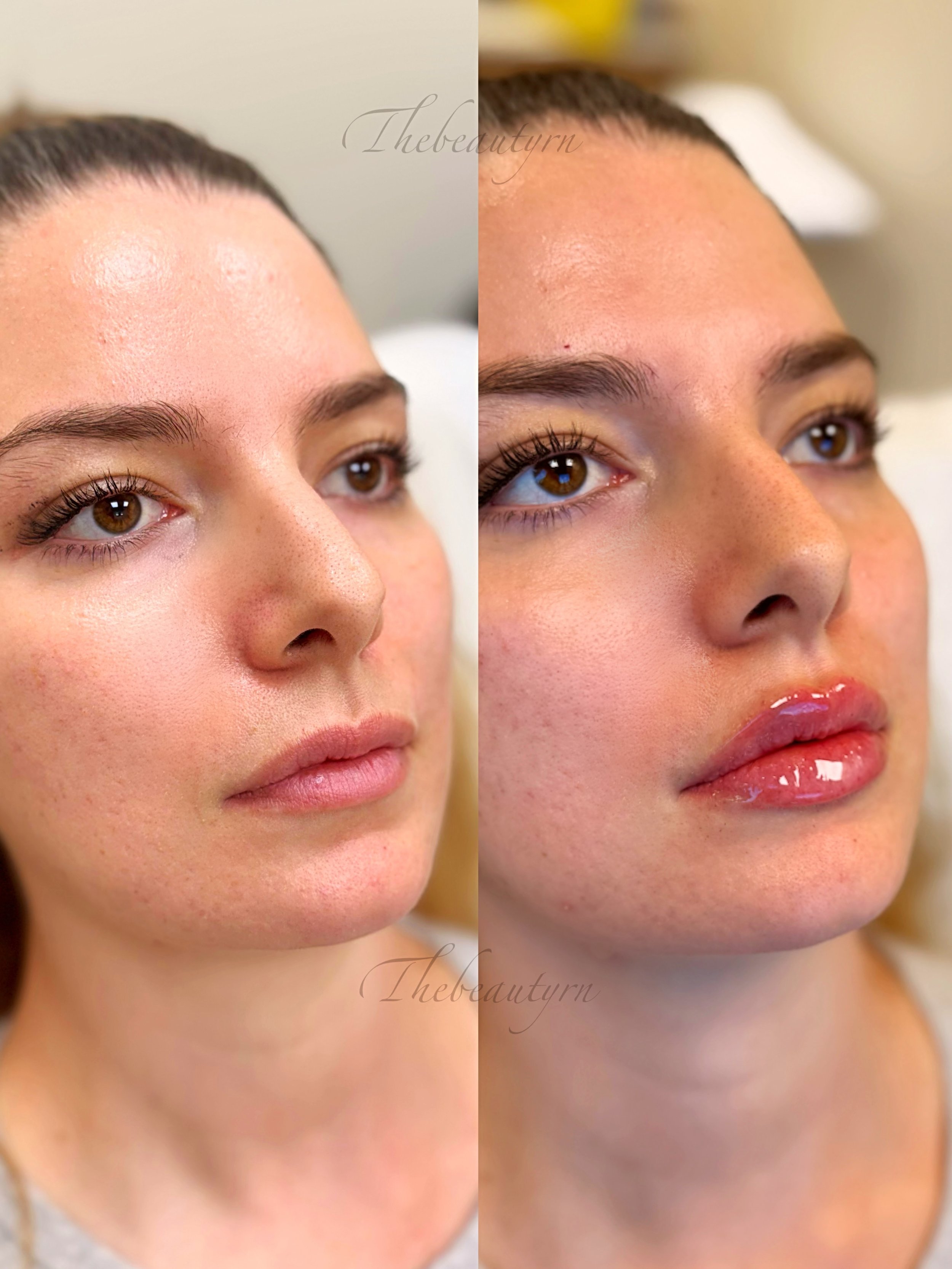 Side-by-side photos showing a woman's face before and after a cosmetic procedure, highlighting smoother skin and enhanced lips.