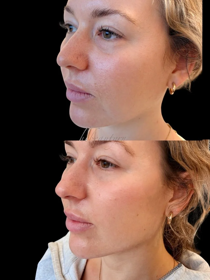 Side-by-side comparison of a woman’s face before and after skincare or cosmetic treatment, with clear skin, light brown hair, and wearing earrings and casual clothing.