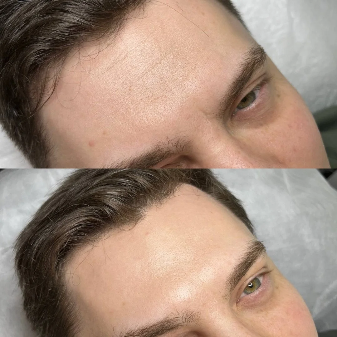 Copy of botox before & after.jpeg