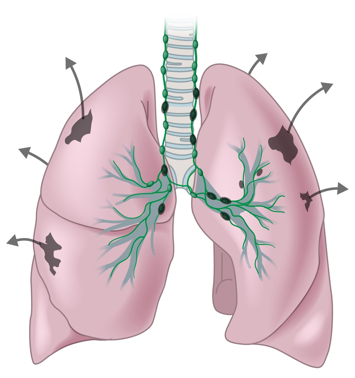 Medical illustration of human lungs showing dark spots indicating stage 4 lung cancer. Dark spots have arrows indicating cancer has spread outside the lungs