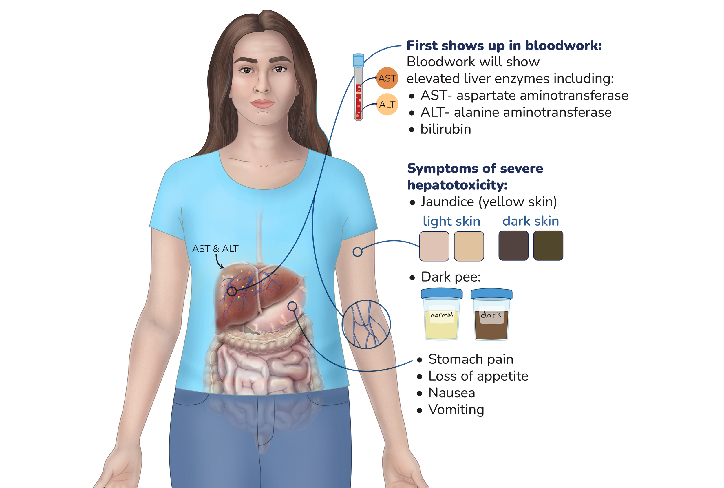 A medical illustration of a woman showing symptoms and laboratory findings related to hepatotoxicity, including elevated liver enzymes (AST and ALT), jaundice with different skin tones, dark urine, stomach pain, loss of appetite, nausea, and vomiting.