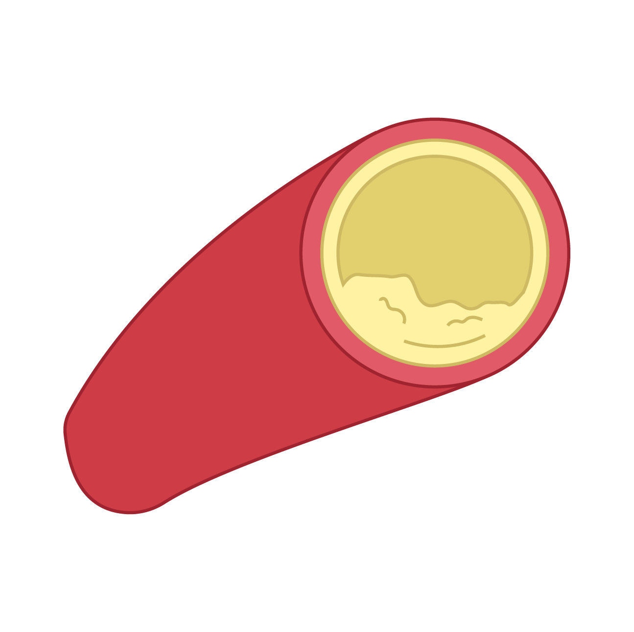 Cross-section of a blood vessel with fat building up to indicate hyperlipidemia which can cause arteries to become blocked.