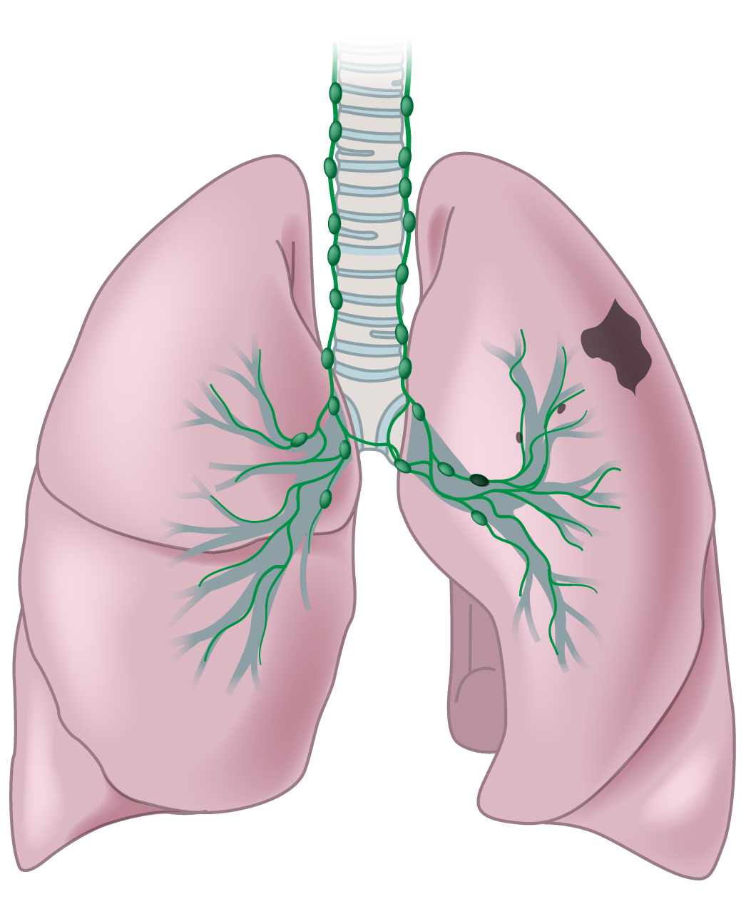 Illustration of a human lungs with bronchial tubes and lymph nodes, showing a dark spot on the right lung indicating stage 2 cancer