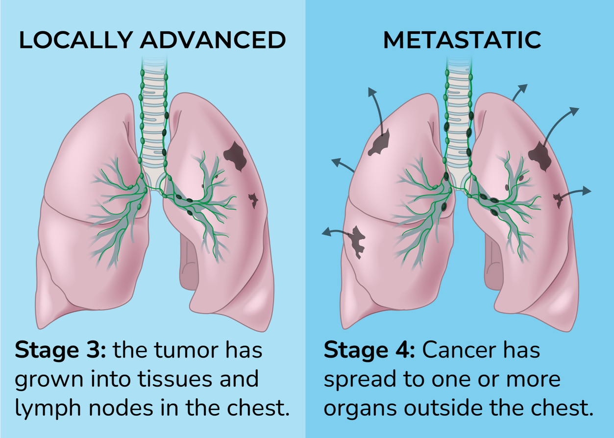 Illustration identifying locally advanced and metastatic cancer. stage 3- the tumour has grown into tissues and lymph nodes in the chest. Stage 4: cancer has spread to one or more organs outside the chest.