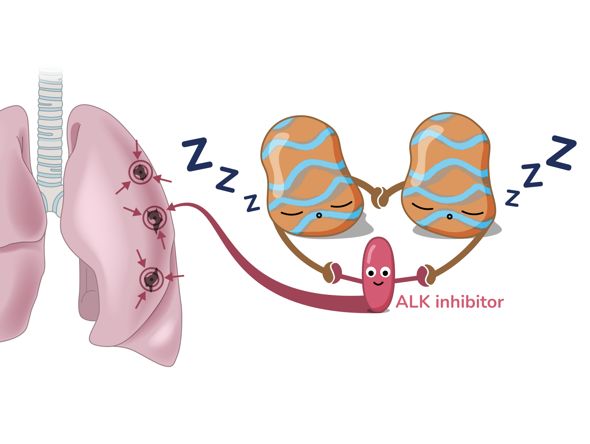 Illustration of an ALK inhibitor drug binding to ALK fusion proteins to stop ALK lung cancer tumour growth.