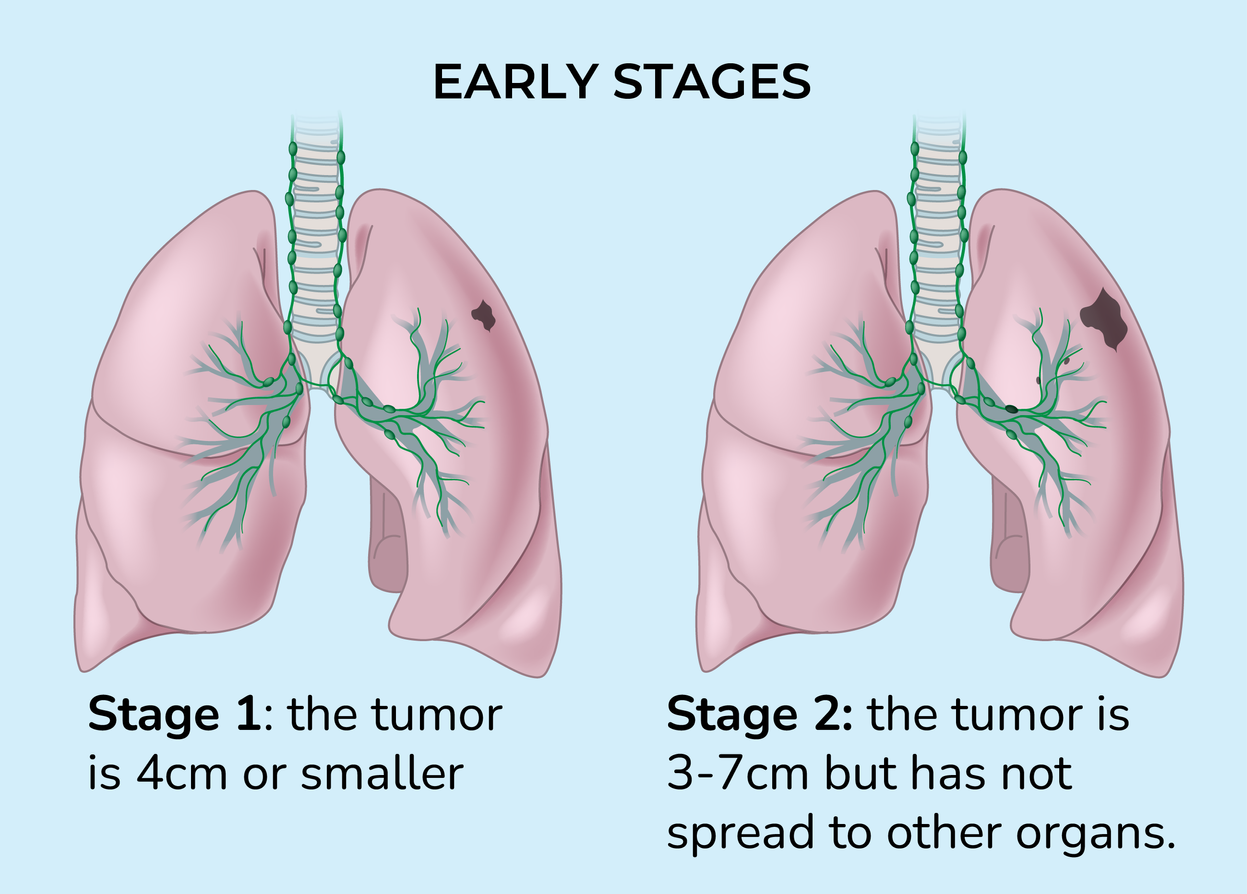 Illustration identifying early stages of lung cancer. stage 1- the tumour is 4cm or smaller, stage 2- the tumour is 3-7cm but has not spread to other organs.