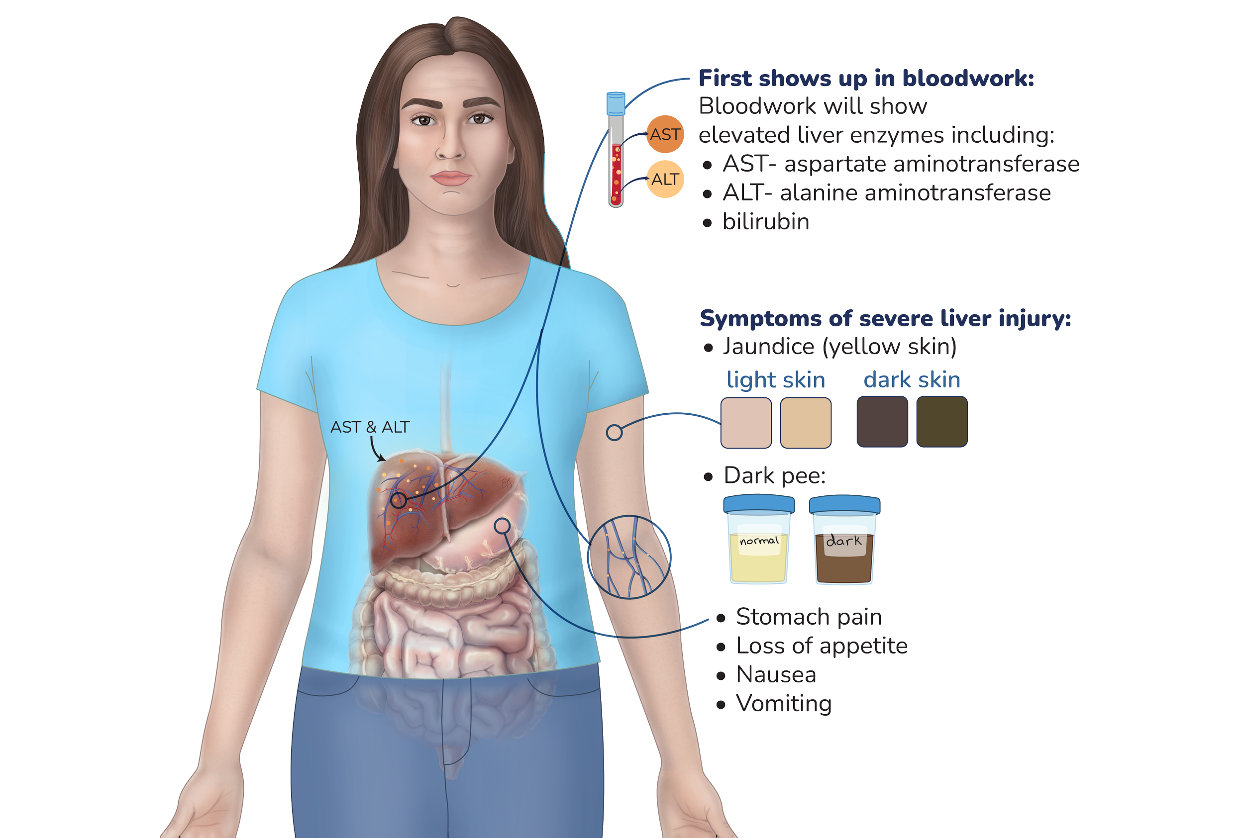 Diagram of a woman with highlighted liver and digestive organs, displaying bloodwork results, symptoms of severe liver injury such as jaundice, dark urine, stomach pain, appetite loss, nausea, and vomiting.