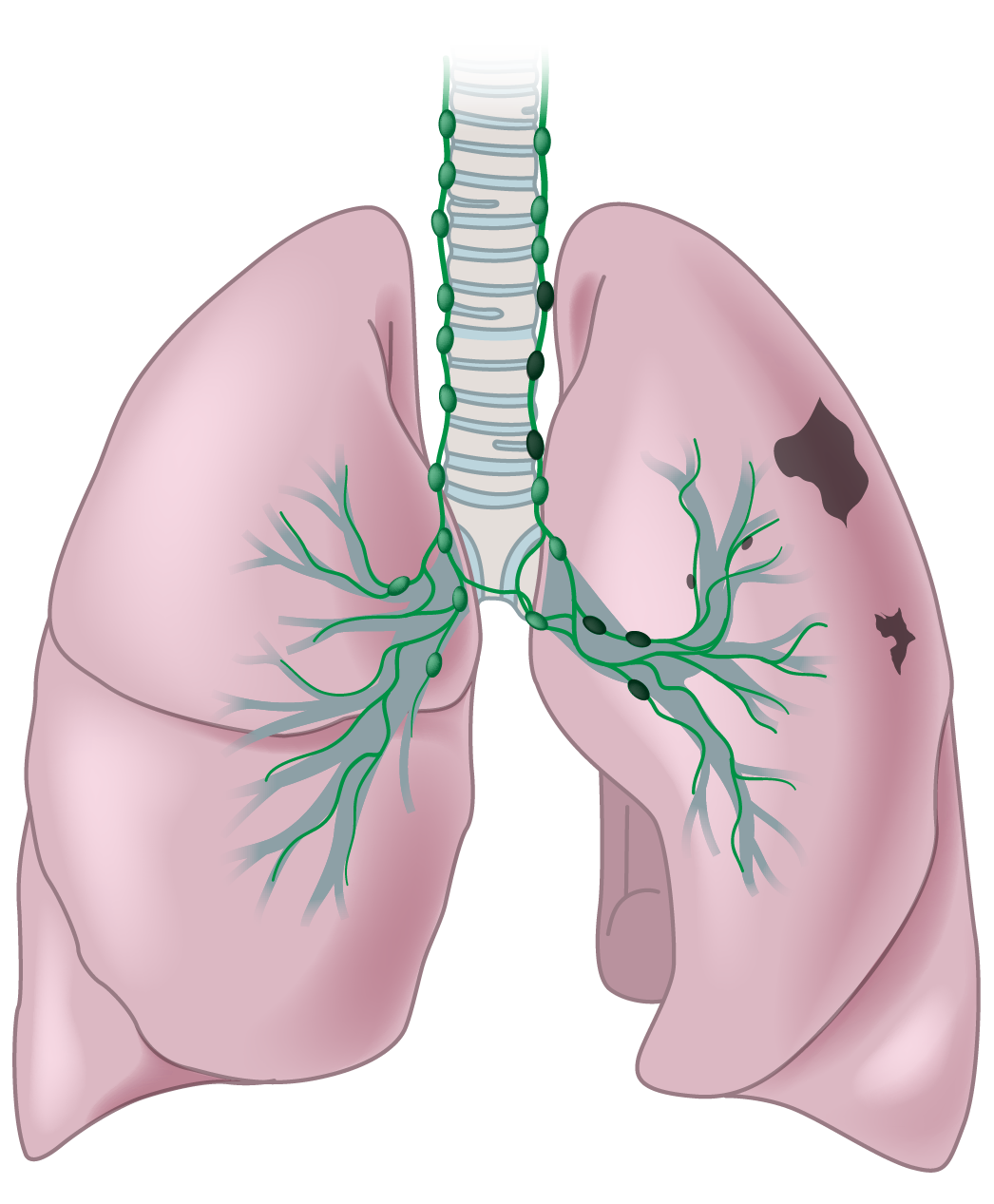 Illustration of human lungs showing dark spots indicating stage 3 lung cancer