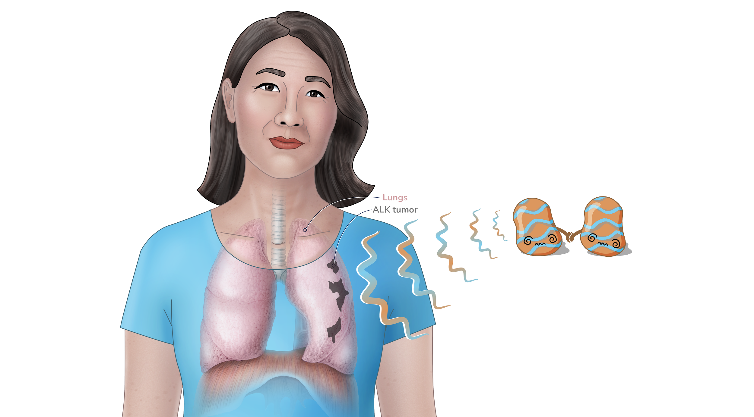 Illustration showing a woman with a detailed view of her lungs, highlighting an ALK tumor in the lungs. ALK-fusion proteins send the signal that turn lung cells cancerous