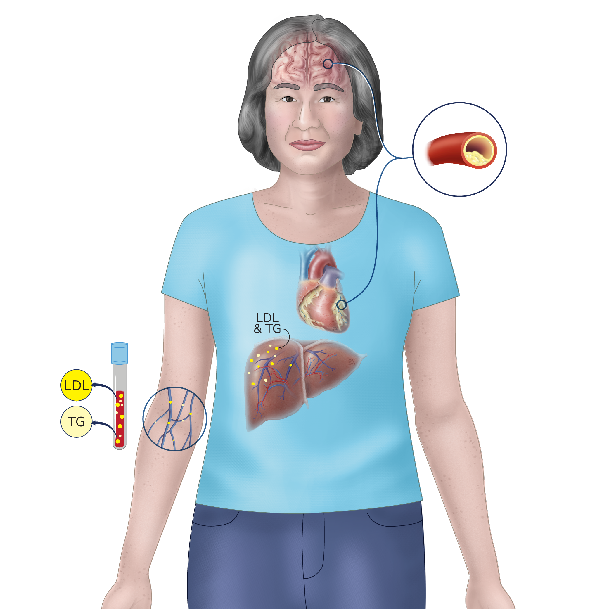 Elderly asian woman standing. Liver, heart and brain are shown transparently. LDL and triglycerides are identified in blood.