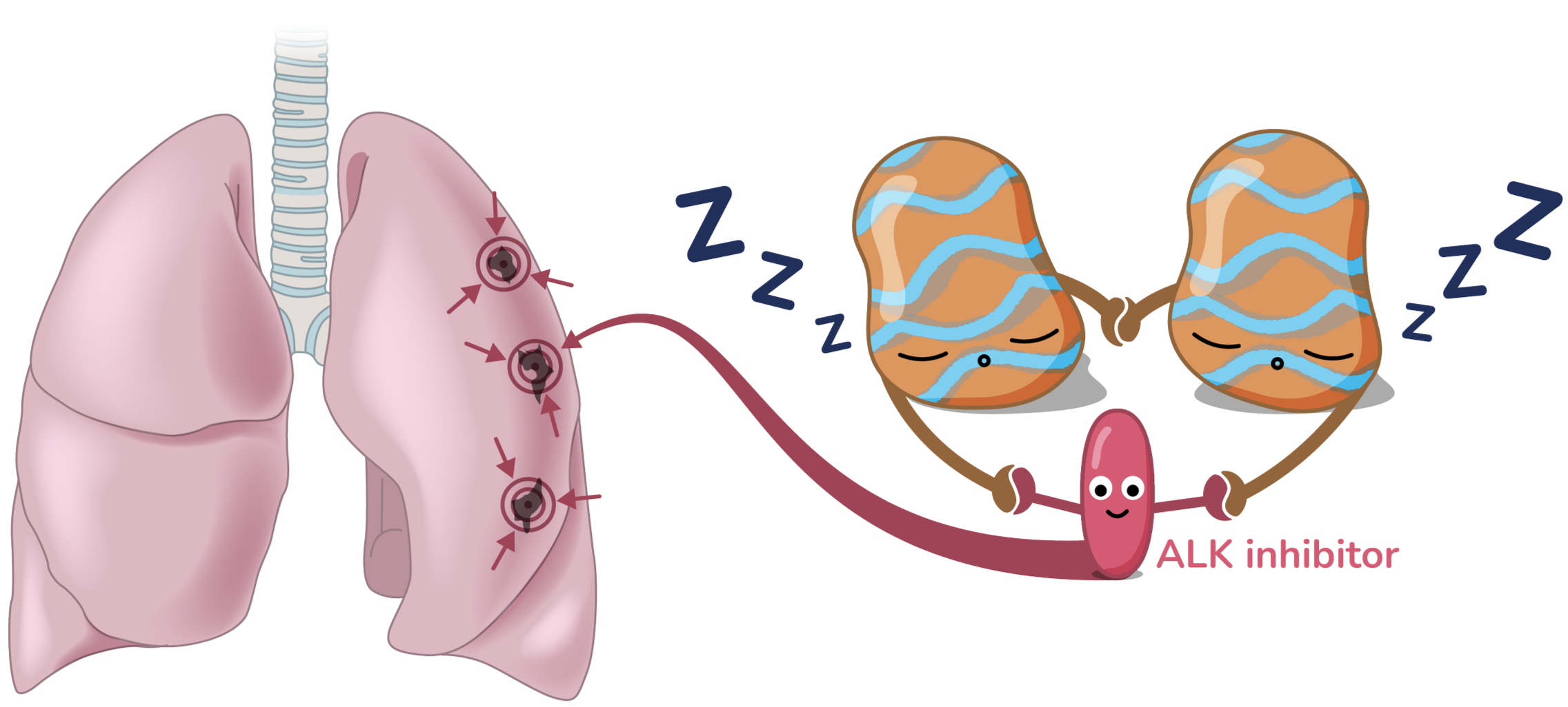 Diagram showing lung tumors shrinking because the ALK inhibitor medication turns off signals from ALK-fusion proteins