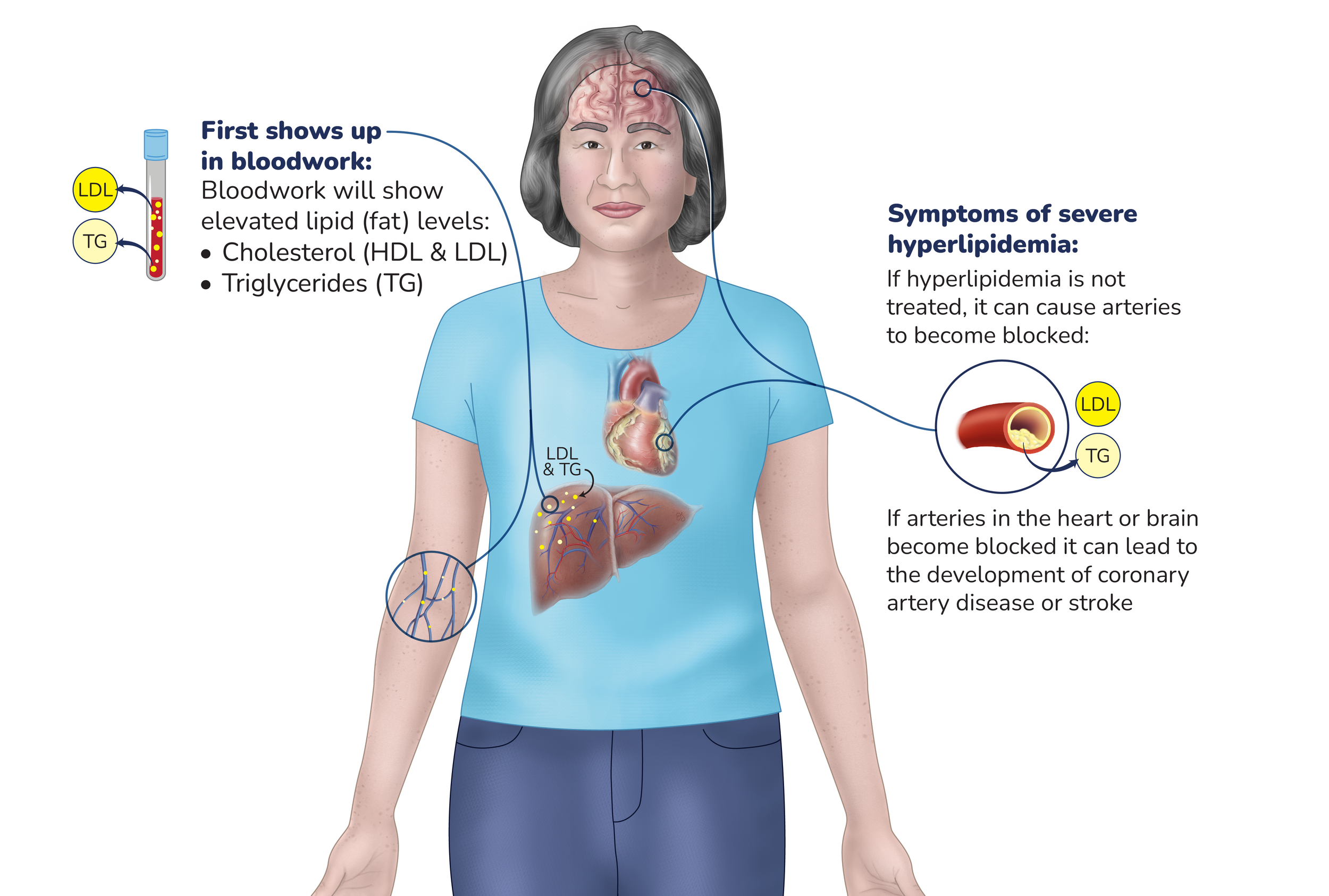 Bloodwork  will show elevated lipid levels (cholesterol and triglycerides). If hyperlipidemia is not treated, it can cause arteries to become blocked. If arteries in the heart or brain are blocked it can lead to coronary artery disease or stroke.
