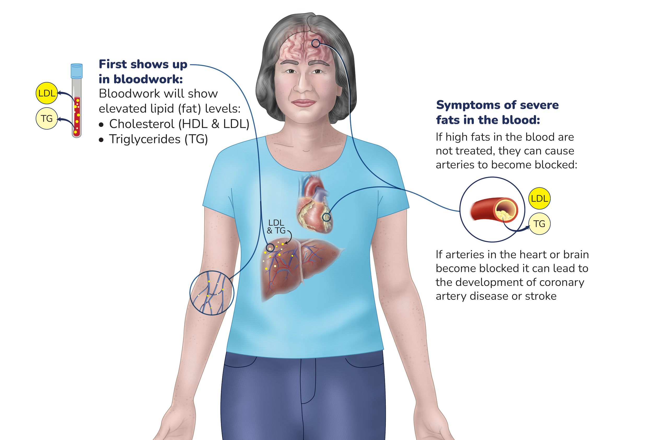 An illustration of a woman showing the effects of high blood fats on health, including elevated lipid levels in the blood, a heart, and blood vessels with a focus on LDL and triglycerides. The image explains how high fats can lead to blocked arteries and health risks like coronary artery disease or stroke.