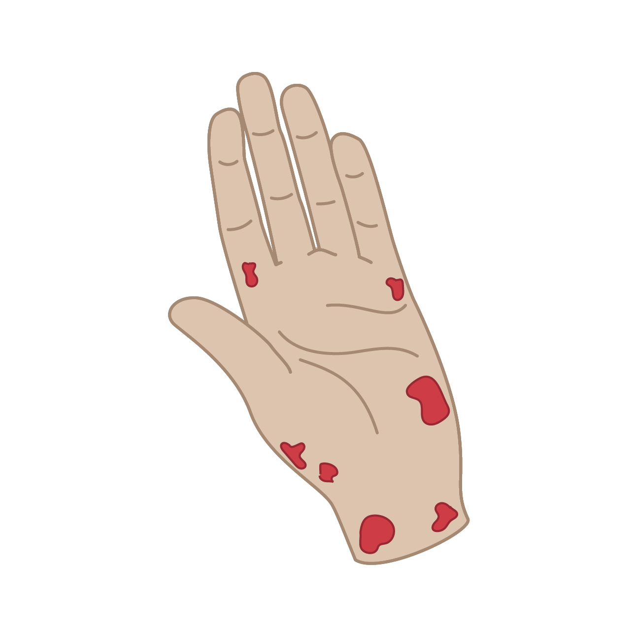 Illustration of a hand with a rash on fingers, palm, and wrist, indicative of a skin condition.