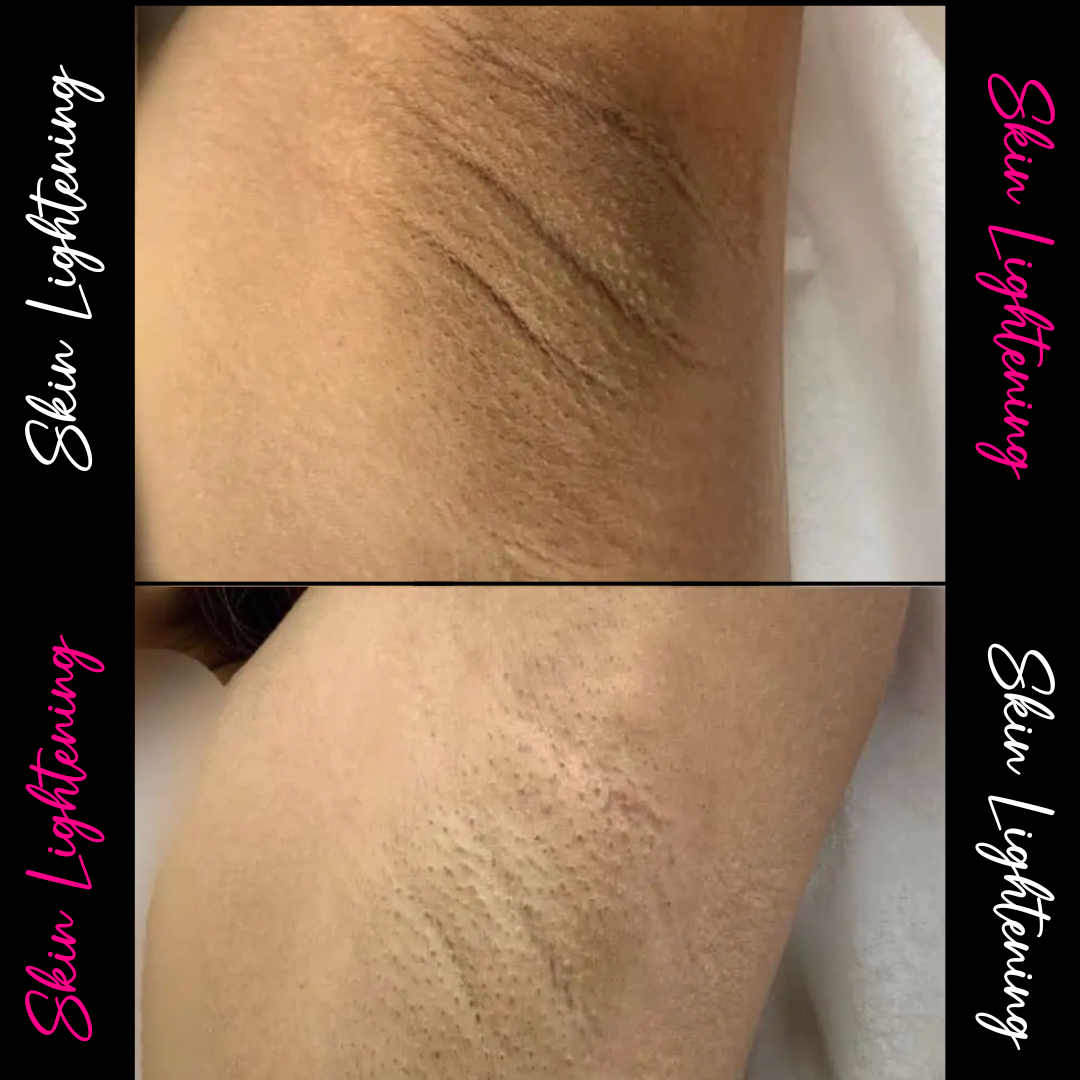 Close-up view of a person's back showing a before-and-after comparison of skin treatment, with the skin appearing smoother and more even in the after image.