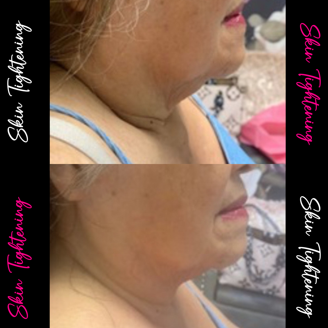 Comparison photo showing a woman's side profile before and after a cosmetic procedure, with the words 'Skin Tightening' and 'Skin Tightening' overlaid on the images.